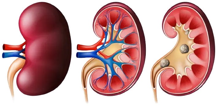Kidney Stone Starting Symptoms: Shifa Hospitals Tirunelveli