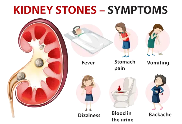 Kidney Stone Starting Symptoms with a simple image